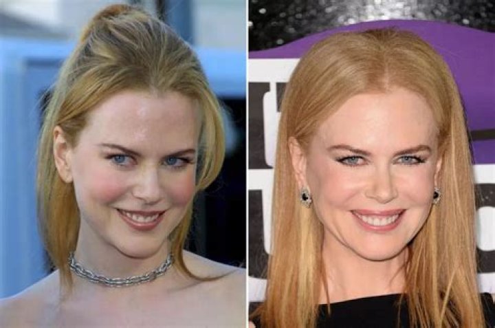 Nicole Kidman: The Evolution Through Plastic Surgery